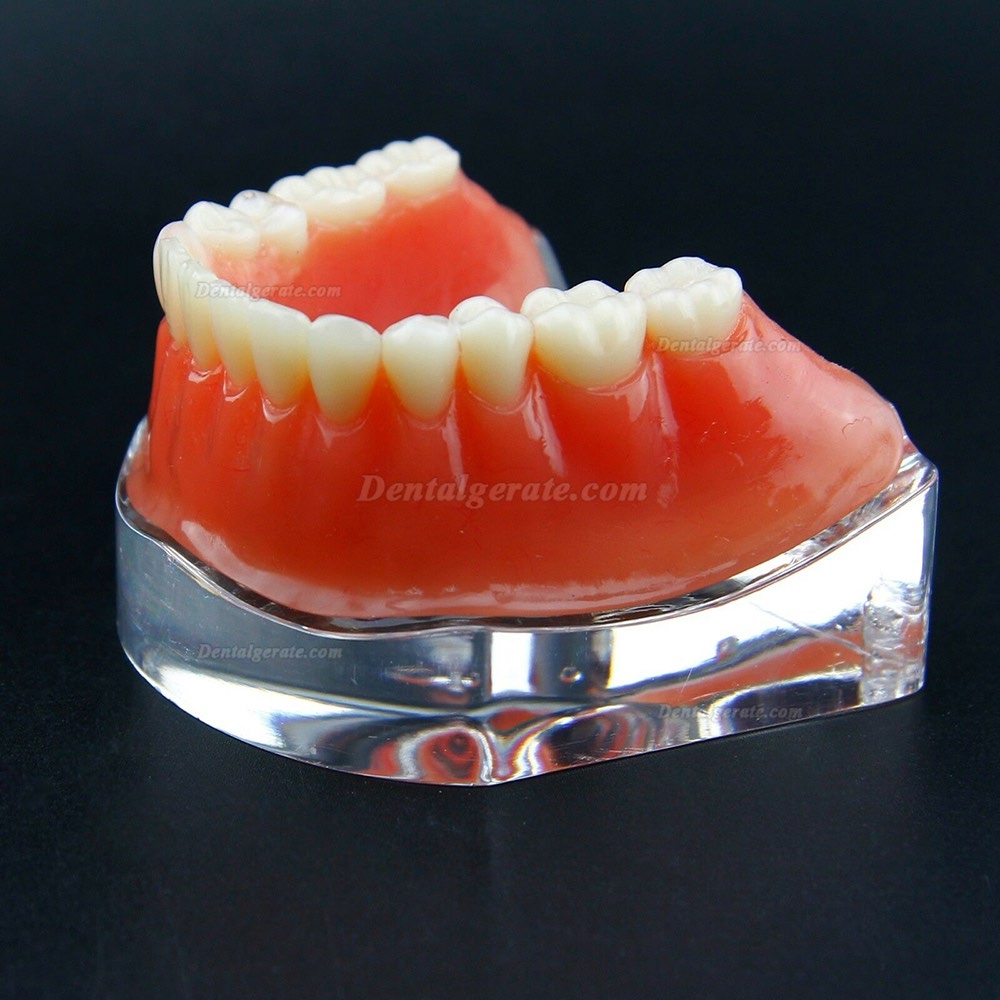 Dental Overdenture Typodont Modell Minderwertiges Pr&auml;zisionsimplantat Golden 6009